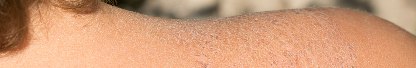 Feuchtigkeitsarme Haut